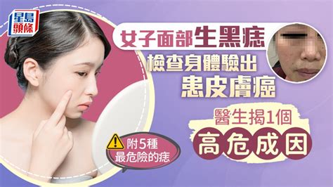 女生長痣|是痣or皮膚癌？醫「1張圖秒對照」 長這2部位最危險